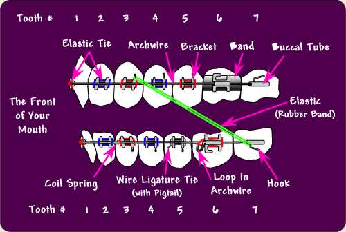 braces parts diagram