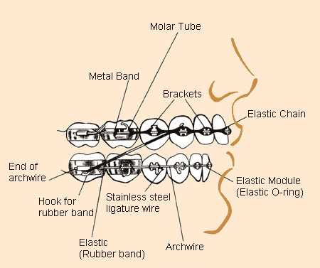 braces parts diagram