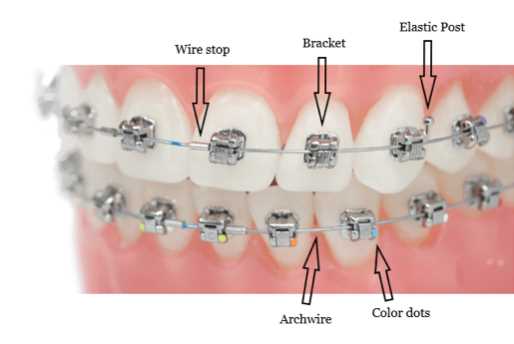 braces parts diagram