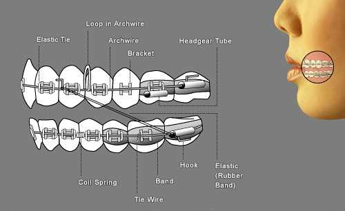 braces parts diagram