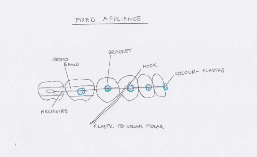 braces parts diagram