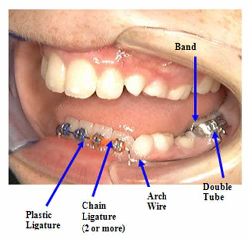 braces parts diagram