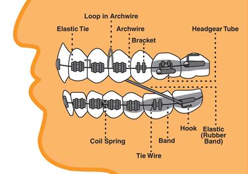 braces parts diagram