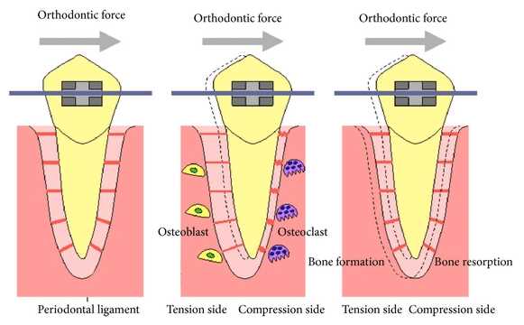 braces parts diagram