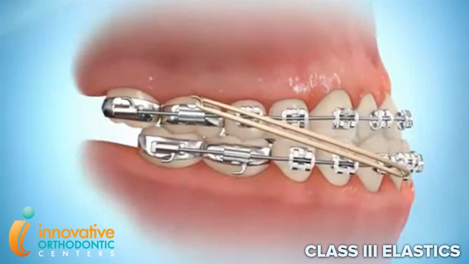 braces parts diagram