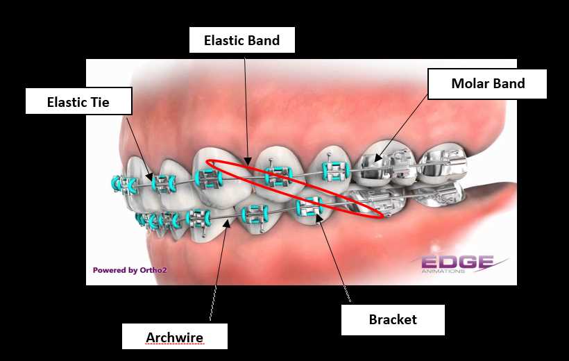 braces parts diagram