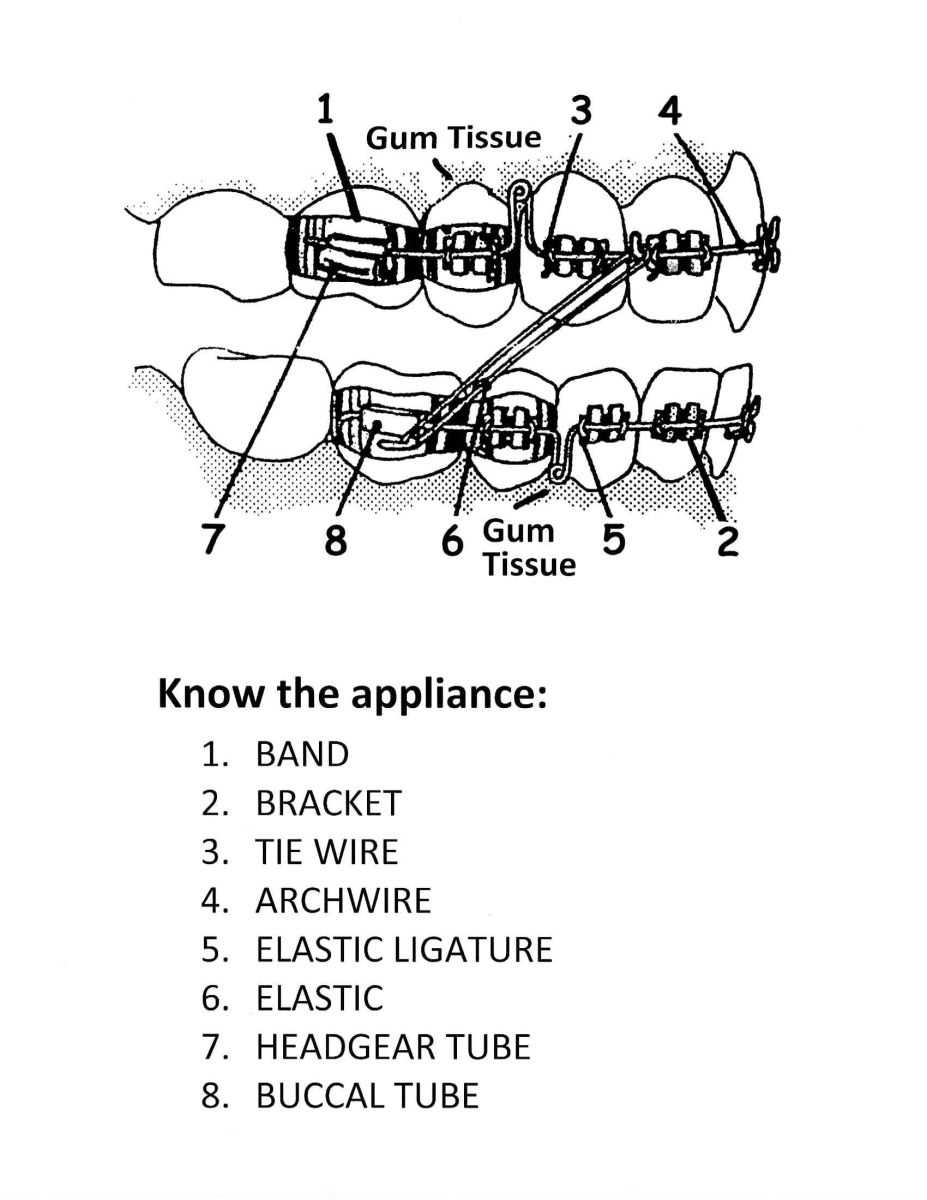 braces parts diagram